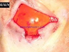 Excision of the tumor can be performed by a MOHS surgeon, an dermatologist, or an ophthalmic plastic surgeon